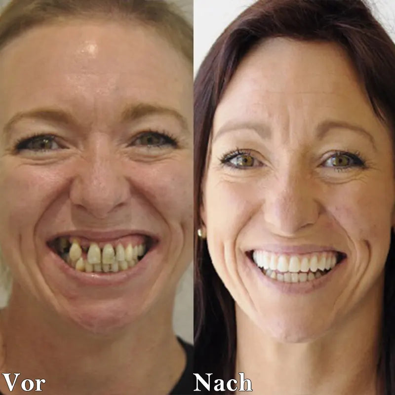 🌷😁Laatste dag korting 👄 Laatste 👨‍⚕ Verstelbare snap-on-gebitsprothesen 🦷 - Exclusieve Aanbieding voor een Stralende Glimlach!