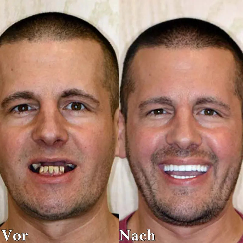 🎉🎉 Laatste Dag Korting 🦷 💝 75% KORTING 👨‍⚕ Natuurlijke Hars Verstelbare Kunstgebitten 😁