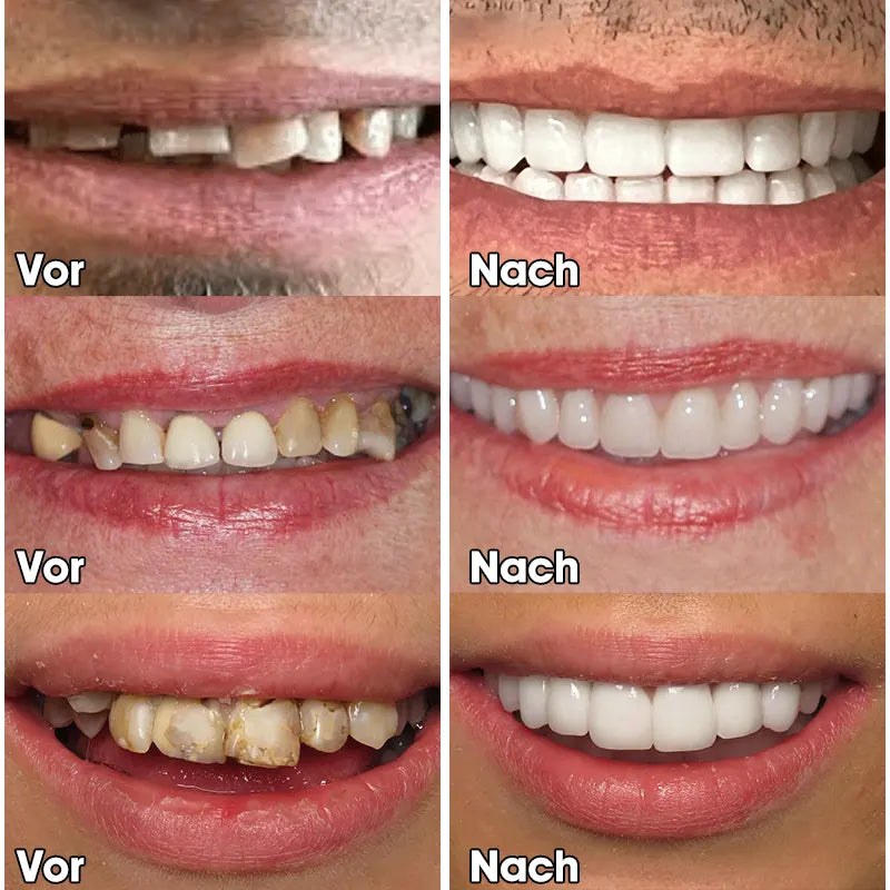 🌷😁Laatste dag korting 👄 Laatste 👨‍⚕ Verstelbare snap-on-gebitsprothesen 🦷 - Exclusieve Aanbieding voor een Stralende Glimlach!