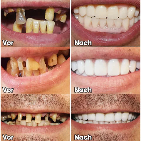 🎁 🦷 Laatste dag korting 💝 Laatste 👨‍⚕ Verstelbare snap-on-gebitsprothesen 😁