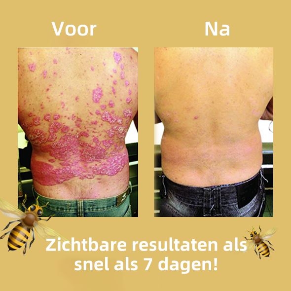 🌈Cvreoz Bijengif Psoriasis Behandelingscreme (👨‍⚕AAD Aanbevolen)🐝🐝