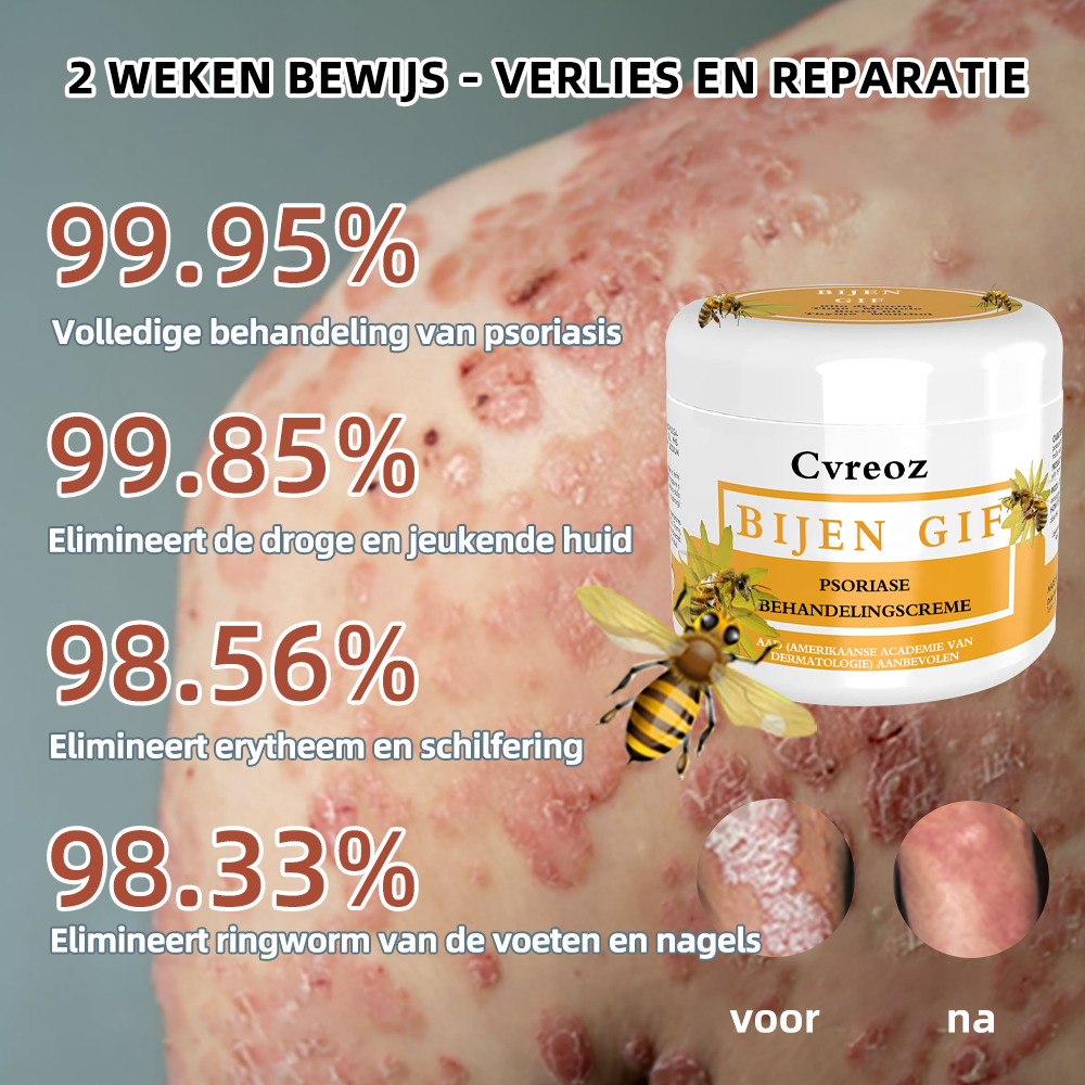 🌈Cvreoz Bijengif Psoriasis Behandelingscreme (👨‍⚕AAD Aanbevolen)🐝🐝